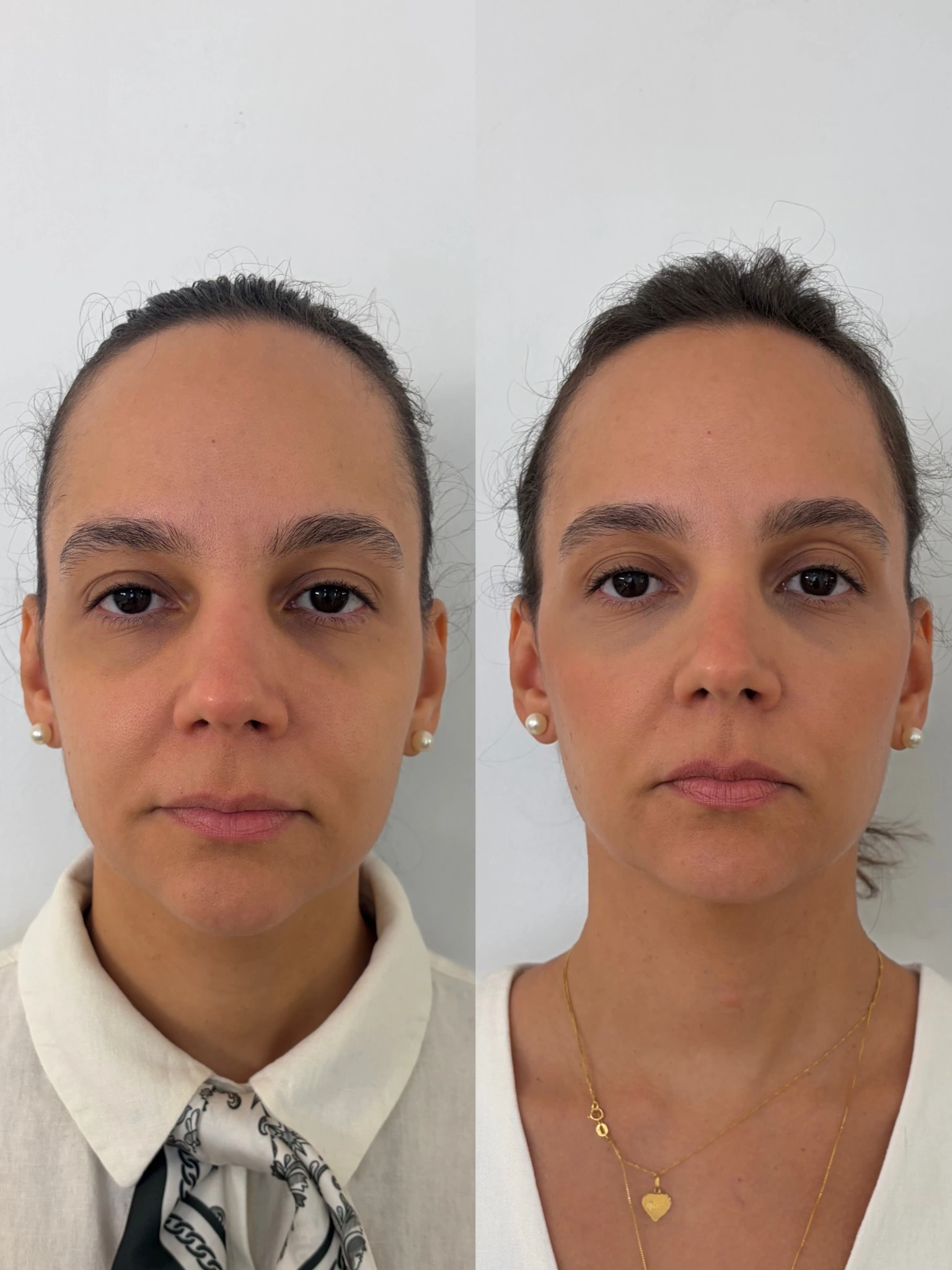 Comparação fotográfica frontal de paciente, apresentada lado a lado